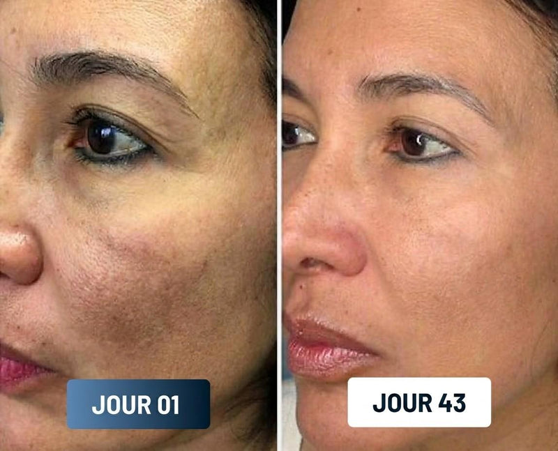 Avant Après