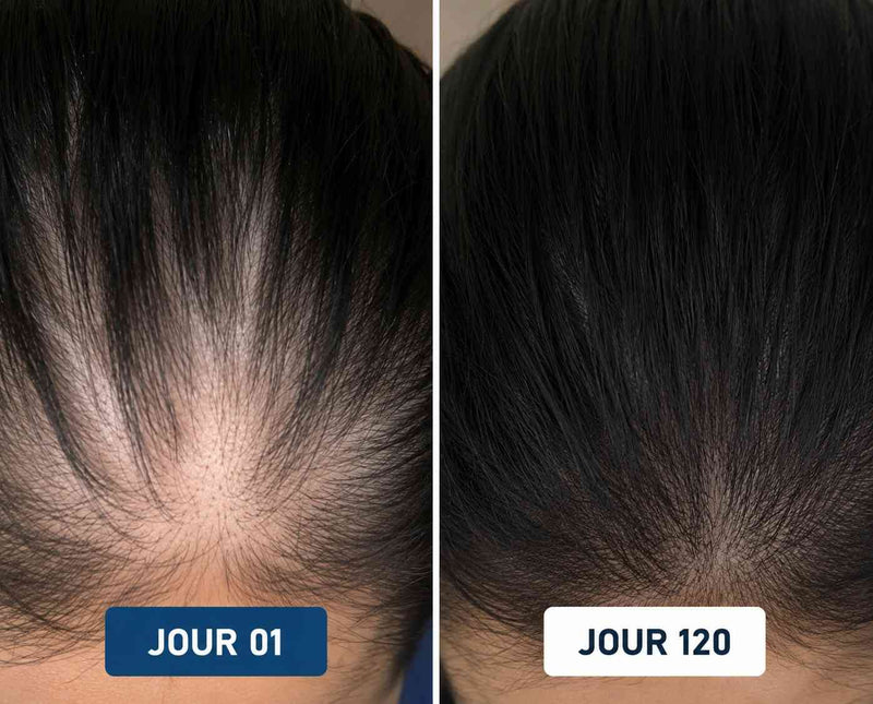 Avant Après